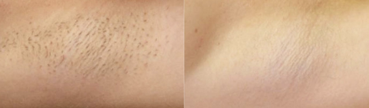 before and after of laser hair removal on under arm in Charlotte, NC