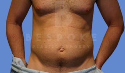 Liposuction Before & After Gallery - Patient 4622785 - Image 1