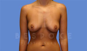 Charlotte NC Before & After Breast Augmentation