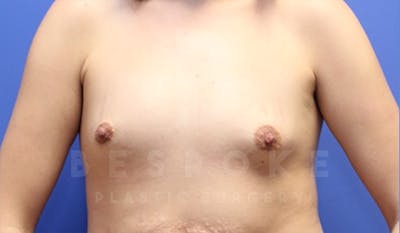 Breast Augmentation Before & After Gallery - Patient 4657402 - Image 1
