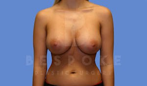 Charlotte NC Before & After Breast Augmentation