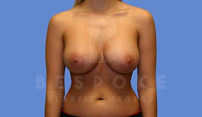 Breast Augmentation Before & After Gallery - Patient 4657401 - Image 2