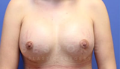 Breast Augmentation Before & After Gallery - Patient 4657402 - Image 2