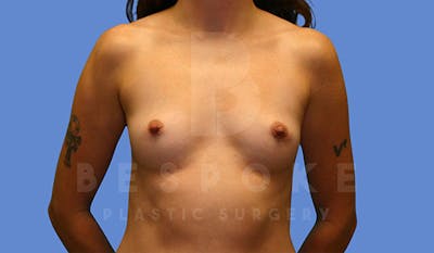 Breast Augmentation Before & After Gallery - Patient 4657403 - Image 1