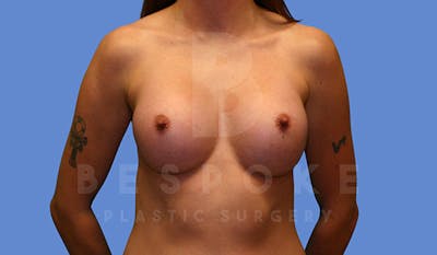 Breast Augmentation Before & After Gallery - Patient 4657403 - Image 2