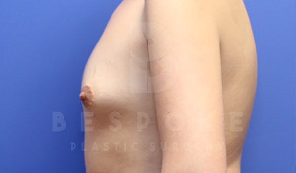 Breast Augmentation Before & After Gallery - Patient 4657402 - Image 5
