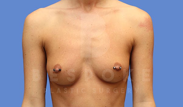 Breast Augmentation Before & After Gallery - Patient 4657404 - Image 1