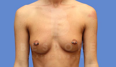Breast Augmentation Before & After Gallery - Patient 4657404 - Image 1