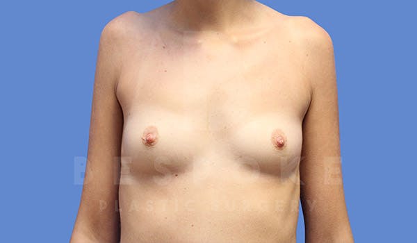Breast Augmentation Before & After Gallery - Patient 4657405 - Image 1
