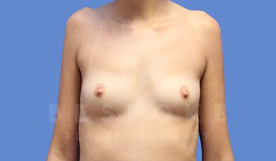 Breast Augmentation Before & After Gallery - Patient 4657405 - Image 1