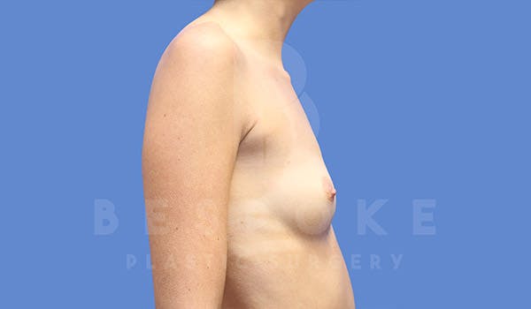 Breast Augmentation Before & After Gallery - Patient 4657405 - Image 5