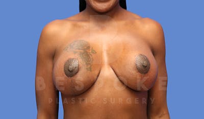 Breast Revision Surgery Before & After Gallery - Patient 4657431 - Image 2