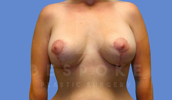 Breast Revision Surgery Before & After Gallery - Patient 4657432 - Image 2
