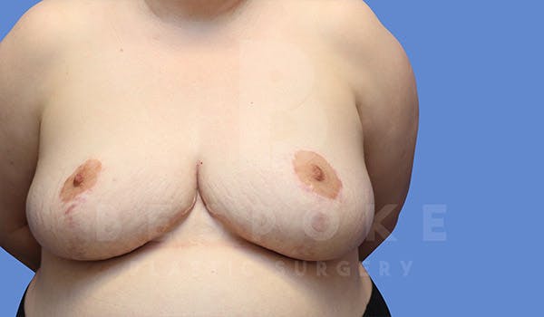 Breast Revision Surgery Before & After Gallery - Patient 4657433 - Image 1