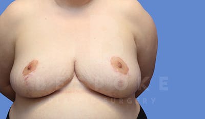 Breast Revision Surgery Before & After Gallery - Patient 4657433 - Image 1