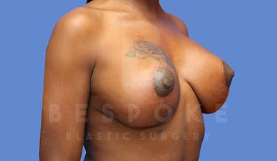 Breast Revision Surgery Before & After Gallery - Patient 4657431 - Image 4