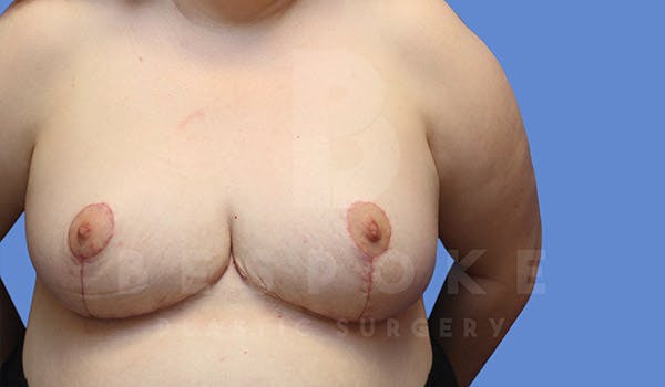 Breast Revision Surgery Before & After Gallery - Patient 4657433 - Image 2