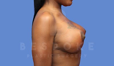 Breast Revision Surgery Before & After Gallery - Patient 4657431 - Image 6