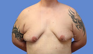 Before & After Gynecomastia Surgery Charlotte NC