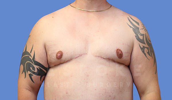 Gynecomastia Before & After Gallery - Patient 4657447 - Image 2