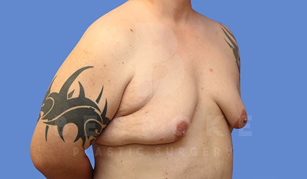 Gynecomastia Before & After Gallery - Patient 4657447 - Image 3