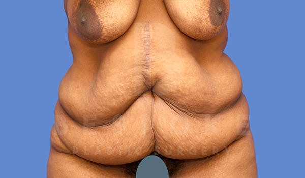 Tummy Tuck Before & After Gallery - Patient 4657454 - Image 1