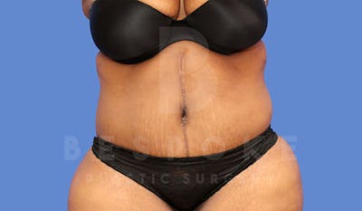 Tummy Tuck Before & After Gallery - Patient 4657454 - Image 2