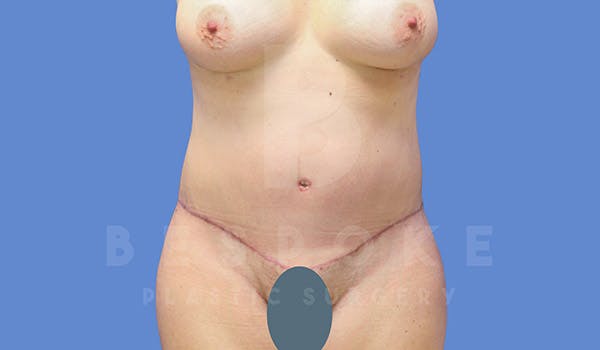 Tummy Tuck Before & After Gallery - Patient 4657455 - Image 2