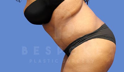 Tummy Tuck Before & After Gallery - Patient 4657454 - Image 4