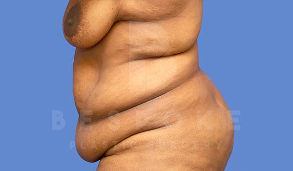 Extended Tummy Tuck Before & After Gallery - Patient 222373 - Image 5