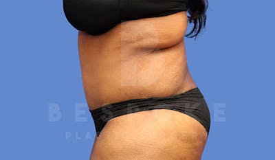 Tummy Tuck Before & After Gallery - Patient 4657454 - Image 6