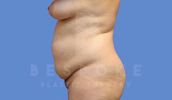 Tummy Tuck Before & After Gallery - Patient 4657455 - Image 5