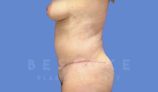 Tummy Tuck Before & After Gallery - Patient 4657455 - Image 6