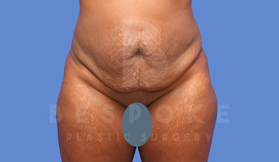Tummy Tuck Before & After Gallery - Patient 4657458 - Image 1