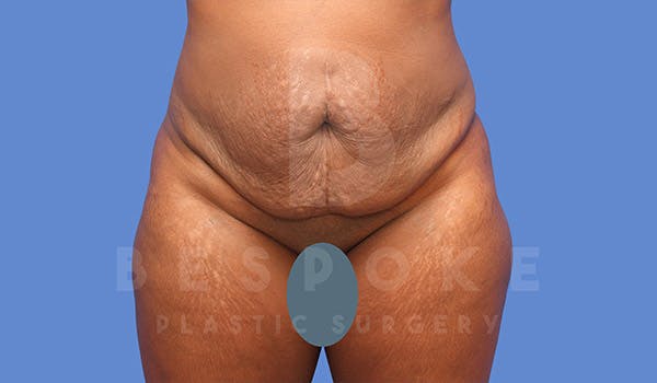 Tummy Tuck Before & After Gallery - Patient 4657458 - Image 1