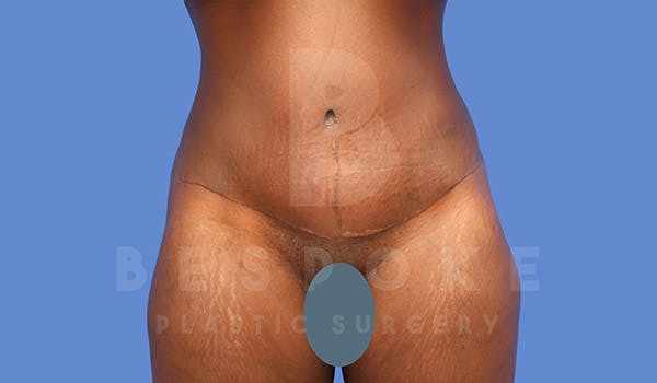 Tummy Tuck Gallery - Patient 4657458 - Image 2