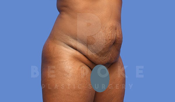 Tummy Tuck Before & After Gallery - Patient 4657458 - Image 3