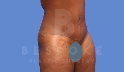 Tummy Tuck Before & After Gallery - Patient 4657458 - Image 4