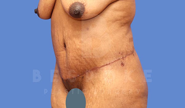 Massive Weight Loss Before & After Gallery - Patient 4657475 - Image 4