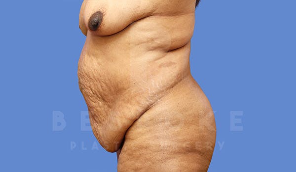 Massive Weight Loss Before & After Gallery - Patient 4657475 - Image 5