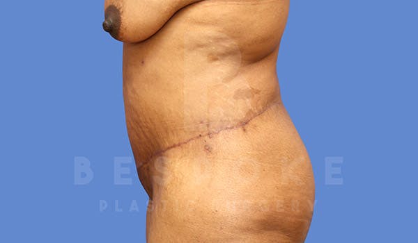 Massive Weight Loss Before & After Gallery - Patient 4657475 - Image 6