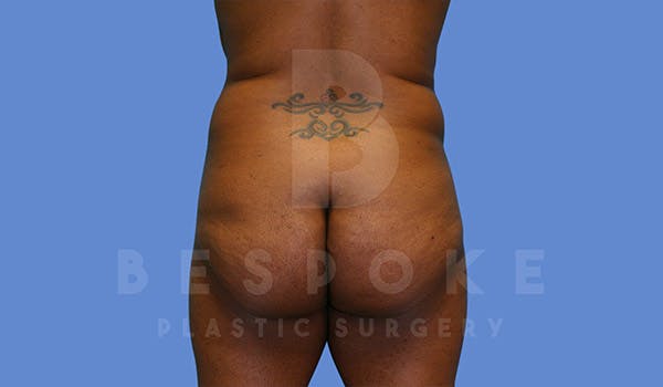 Brazilian Butt Lift Before & After Gallery - Patient 4657484 - Image 1
