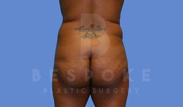 Brazilian Butt Lift Before & After Gallery - Patient 4657484 - Image 1