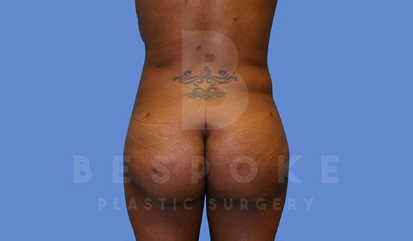 Brazilian Butt Lift Before & After Gallery - Patient 4657484 - Image 2