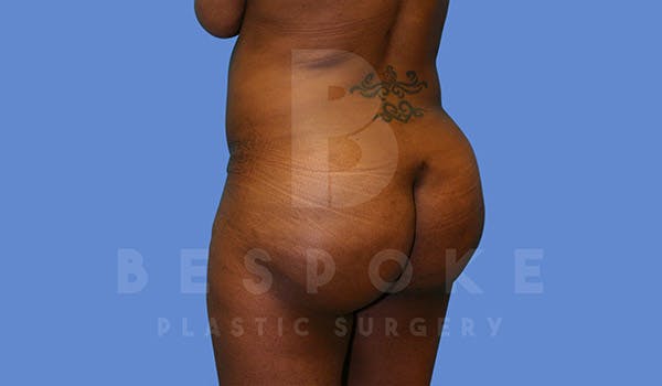 Brazilian Butt Lift Before & After Gallery - Patient 4657484 - Image 4