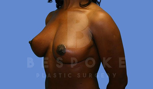 Mommy Makeover Before & After Gallery - Patient 4657486 - Image 4