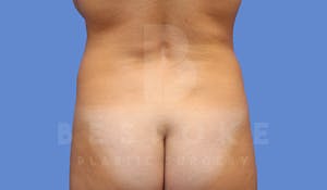 Liposuction Before & After Photos Charlotte NC