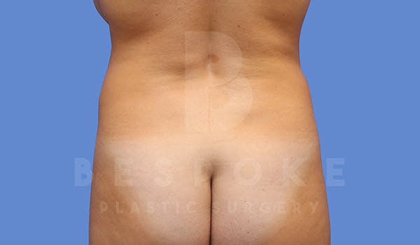 Liposuction Before & After Gallery - Patient 4657489 - Image 1