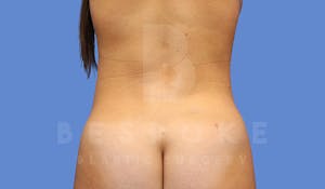 Liposuction Before & After Photos Charlotte NC