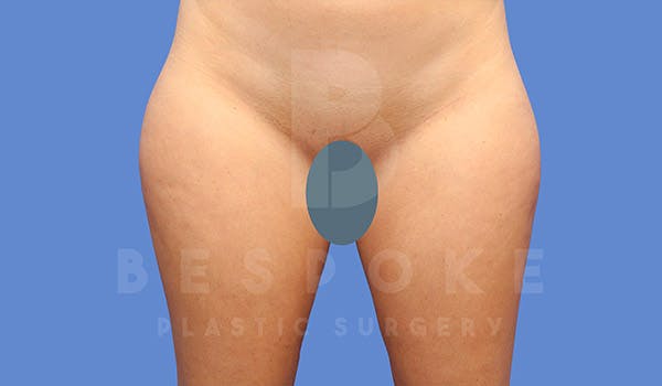 Liposuction Gallery - Patient 4657493 - Image 1